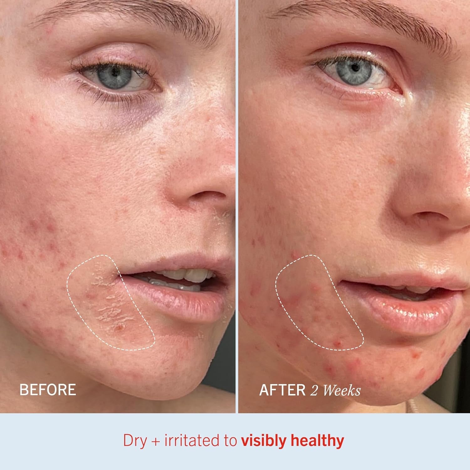 Ultra Repair Cream Intensive Hydration Daily Moisturiser for Face + Body – Strengthens Skin Barrier + Instantly Relieves Dry, Distressed Skin – 170.1 G + Bonus 28.3 G Travel Size-Amene Beauty
